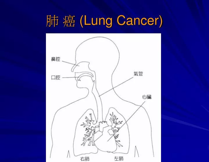 lung cancer