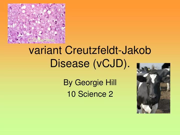 variant creutzfeldt jakob disease vcjd