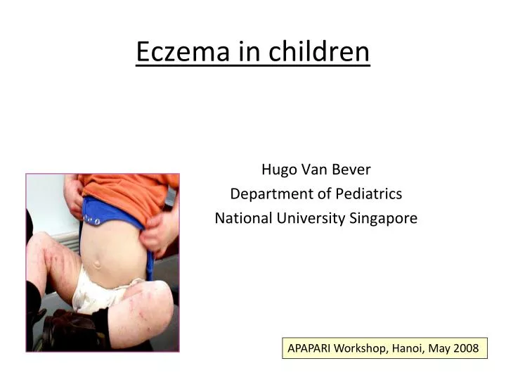 eczema in children