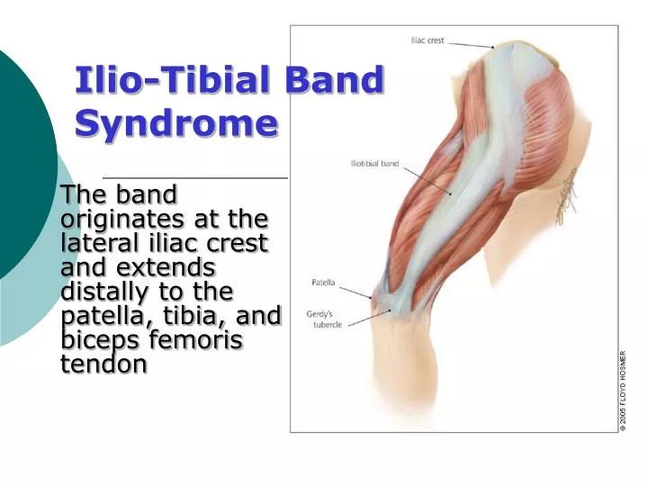 ilio tibial band syndrome