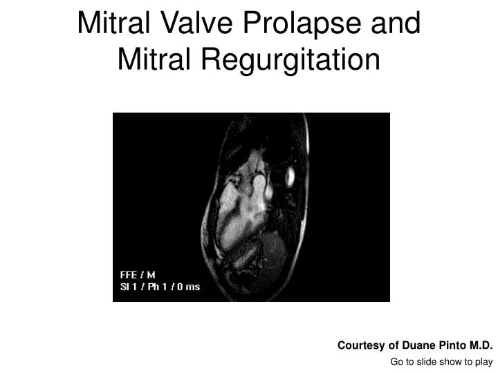 mitral valve prolapse and mitral regurgitation