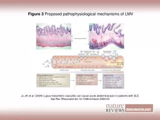 Figure 3 Proposed pathophysiological mechanisms of LMV