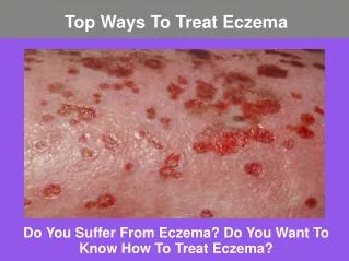 Top Ways To Treat Eczema