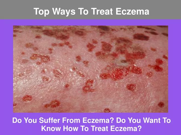 do you suffer from eczema do you want to know how to treat eczema