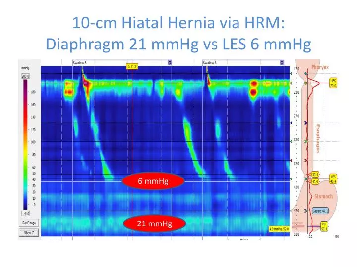 10 cm hiatal hernia via hrm diaphragm 21 mmhg vs les 6 mmhg