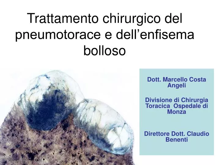 trattamento chirurgico del pneumotorace e dell enfisema bolloso