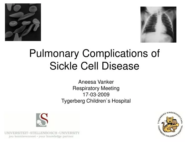 pulmonary complications of sickle cell disease