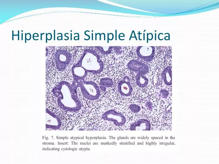 hiperplasia simple at pica