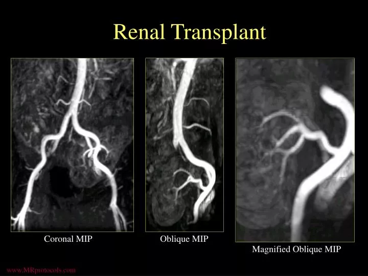 renal transplant