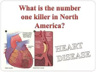 What is the number one killer in North America?