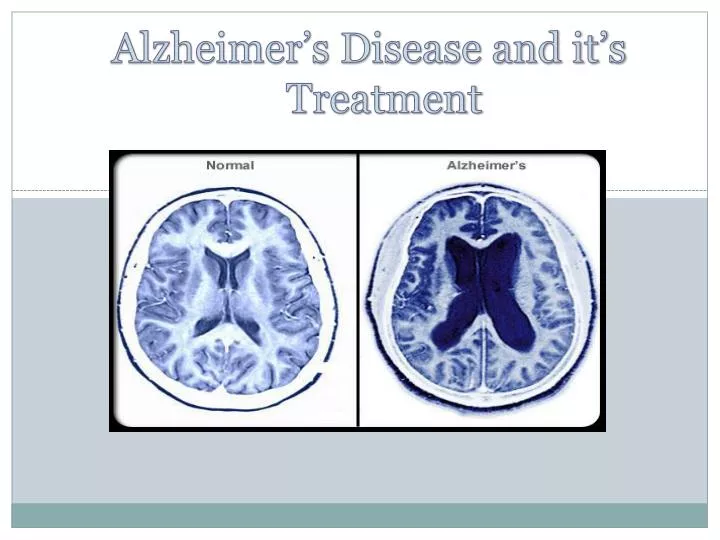 alzheimer s disease and it s treatment