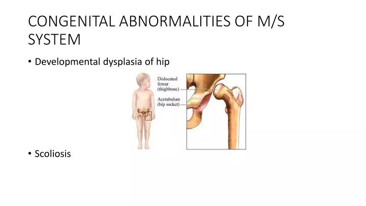 congenital abnormalities of m s system
