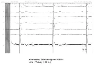 Infra-hissian Second degree AV Block Long HV delay (152 ms)