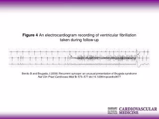 Benito B and Brugada J (2006) Recurrent syncope: an unusual presentation of Brugada syndrome