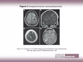 Figure 3 Intraparenchymal neurocysticercosis
