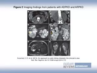 Figure 2 Imaging findings from patients with ADPKD and ARPKD