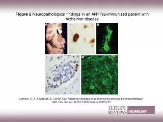 Figure 2 Neuropathological findings in an AN1792?immunized patient with Alzheimer disease