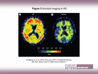 Figure 3 Amyloid imaging in AD