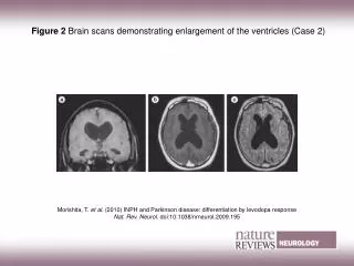 Figure 2 Brain scans demonstrating enlargement of the ventricles (Case 2)