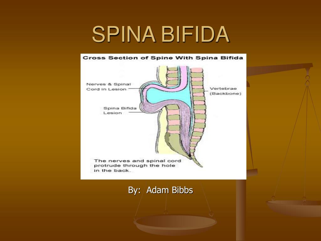 PPT - SPINA BIFIDA PowerPoint Presentation, free download - ID:6875443