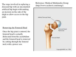 Removing the Femoral Head