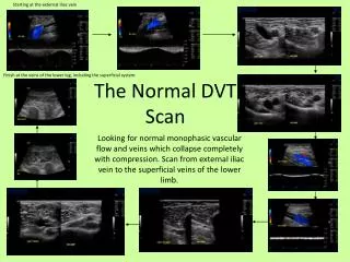 The Normal DVT Scan