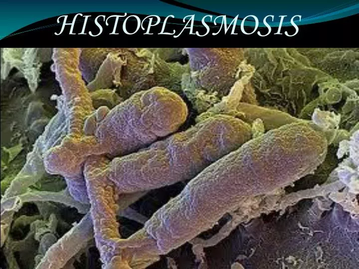 histoplasmosis