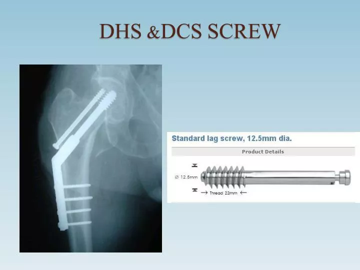 dhs dcs screw