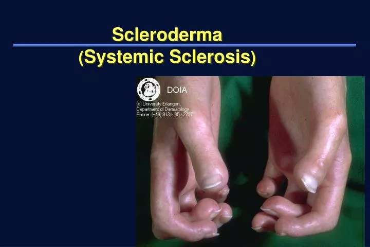 scleroderma systemic sclerosis