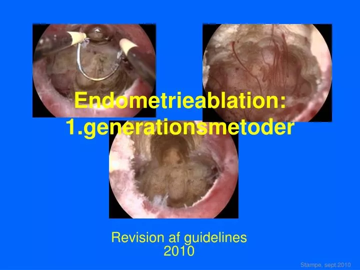 endometrieablation 1 generationsmetoder