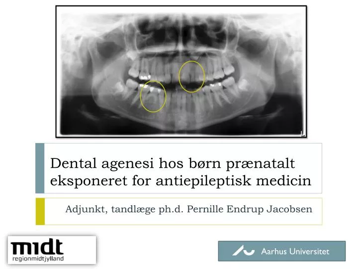 dental agenesi hos b rn pr natalt eksponeret for antiepileptisk medicin