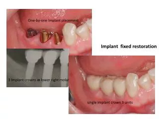 3 Implant crowns i n lower right molar