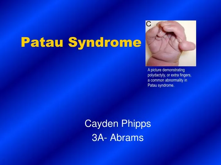 patau syndrome