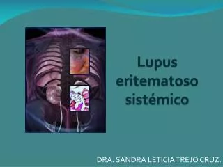 lupus eritematoso sist mico