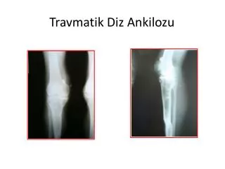 travmatik diz ankilozu