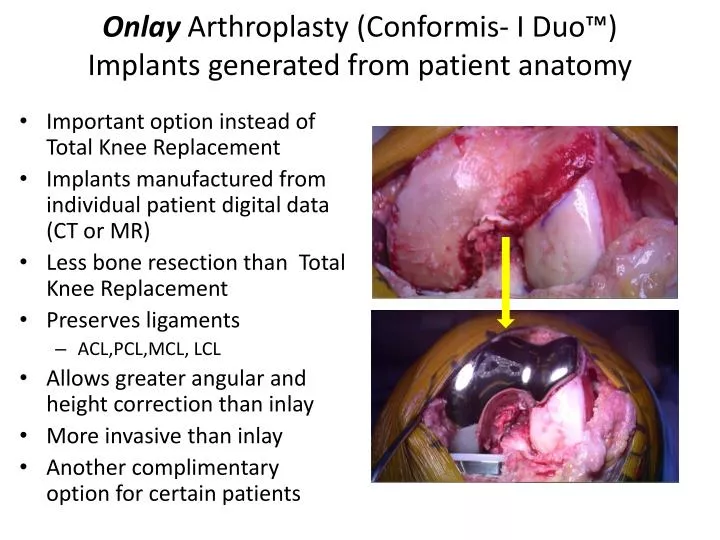 onlay arthroplasty conformis i duo implants generated from patient anatomy