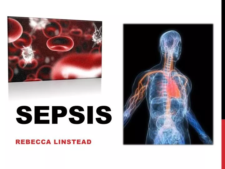 sepsis