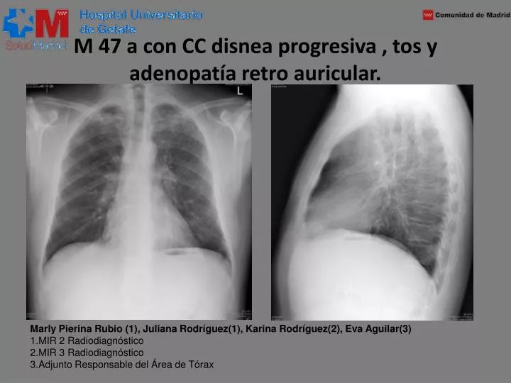 m 47 a con cc disnea progresiva tos y adenopat a retro auricular