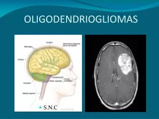 OLIGODENDRIOGLIOMAS