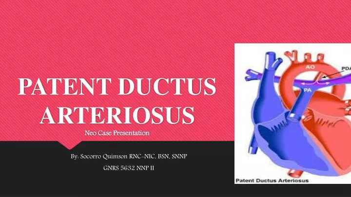 patent ductus arteriosus neo case presentation