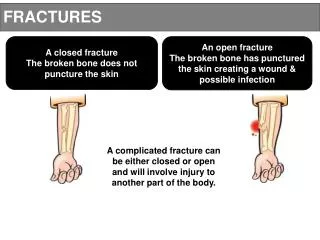 A closed fracture The broken bone does not puncture the skin