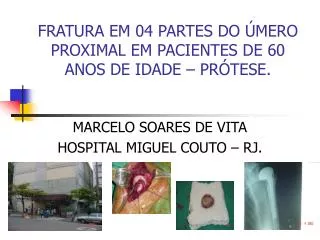 FRATURA EM 04 PARTES DO ÚMERO PROXIMAL EM PACIENTES DE 60 ANOS DE IDADE – PRÓTESE.