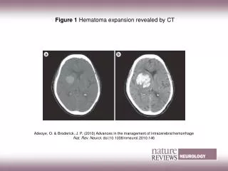 Figure 1 Hematoma expansion revealed by CT