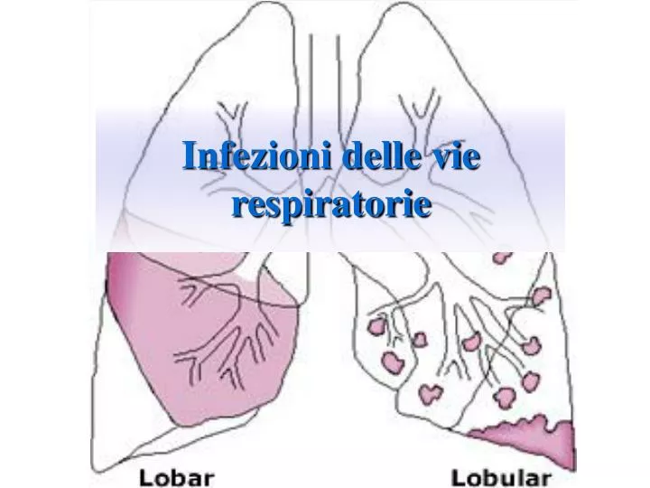 infezioni delle vie respiratorie