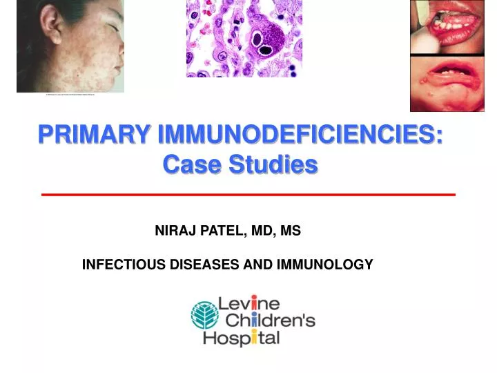 primary immunodeficiencies case studies
