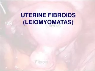 UTERINE FIBROIDS (LEIOMYOMATAS)