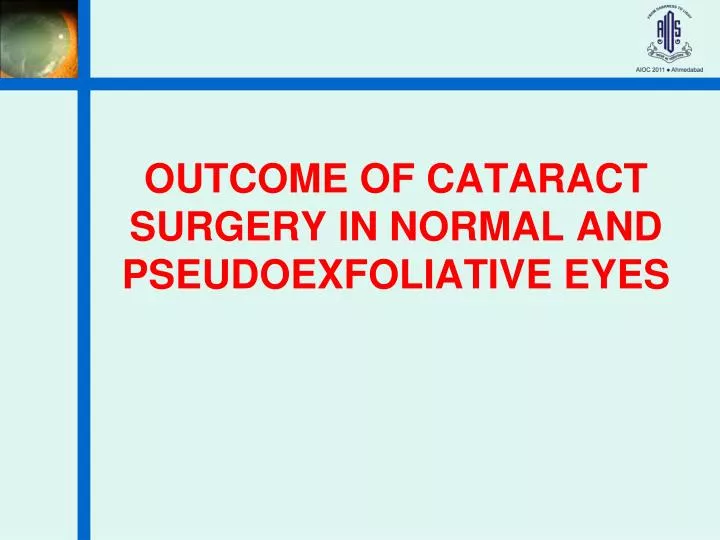 outcome of cataract surgery in normal and pseudoexfoliative eyes
