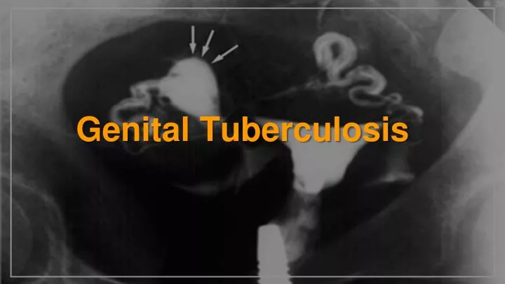 genital tuberculosis
