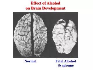 Effect of Alcohol on Brain Development