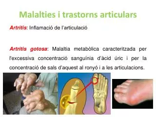 Artritis : Inflamació de l’articulació